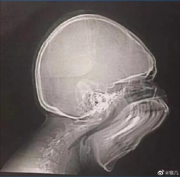 拍牙片時打了個哈欠，變成了毒液？用3D打印技術制作牙齒的好處